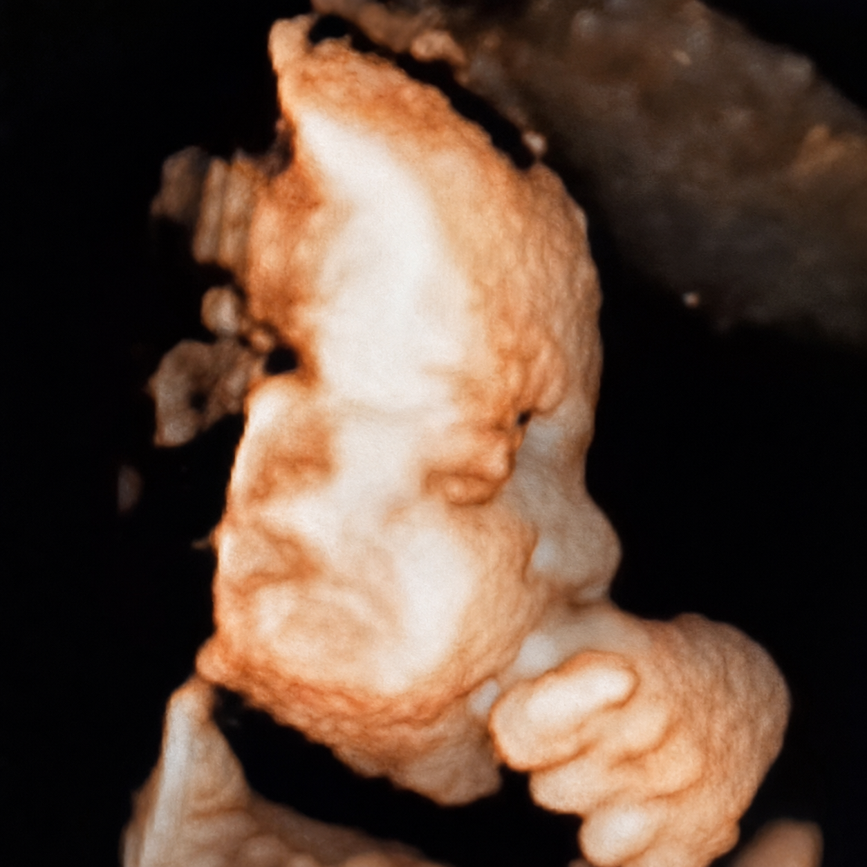 Imagem tridimensional de ultrassonografia fetal